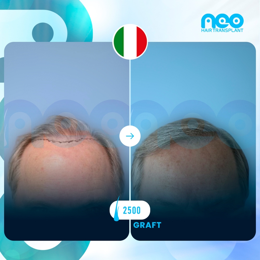 Neo Hair Before After 0