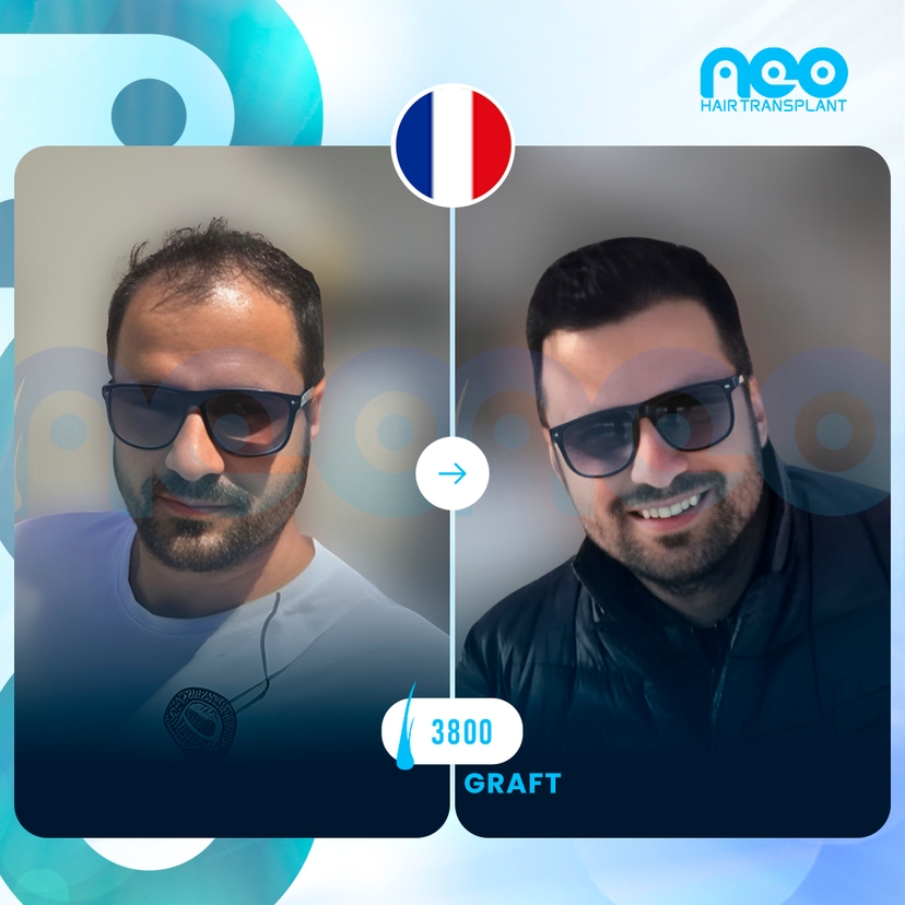 Neo Hair Before After 9