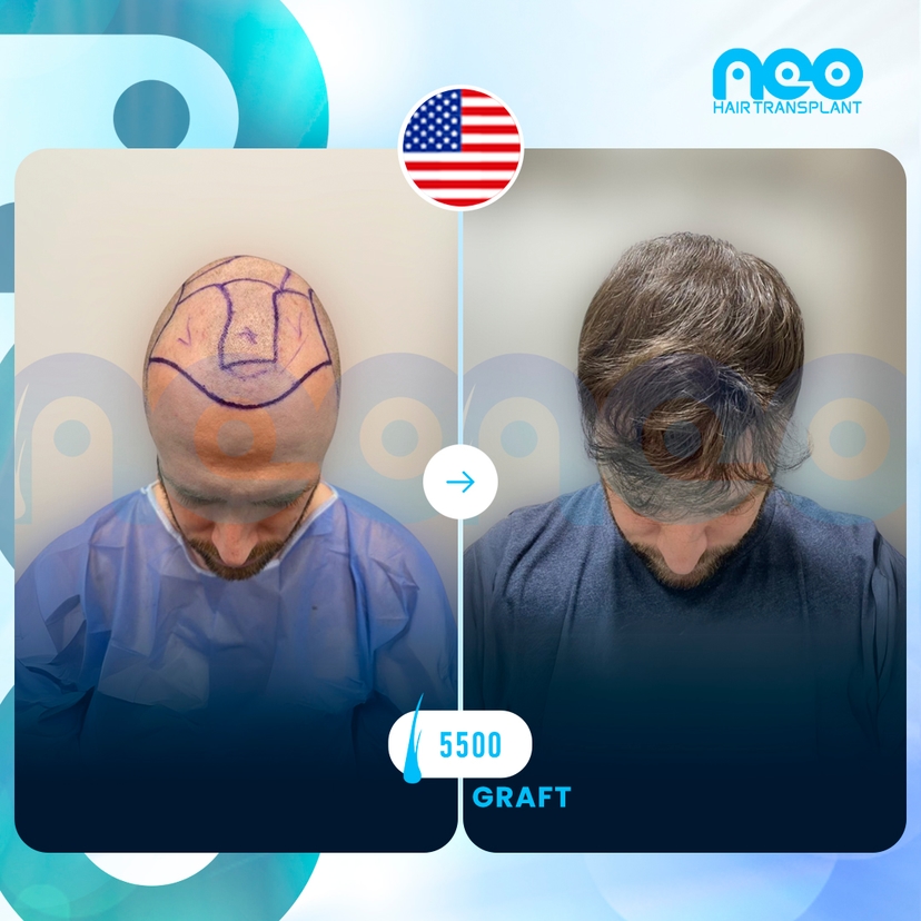 Neo Hair Before After 10
