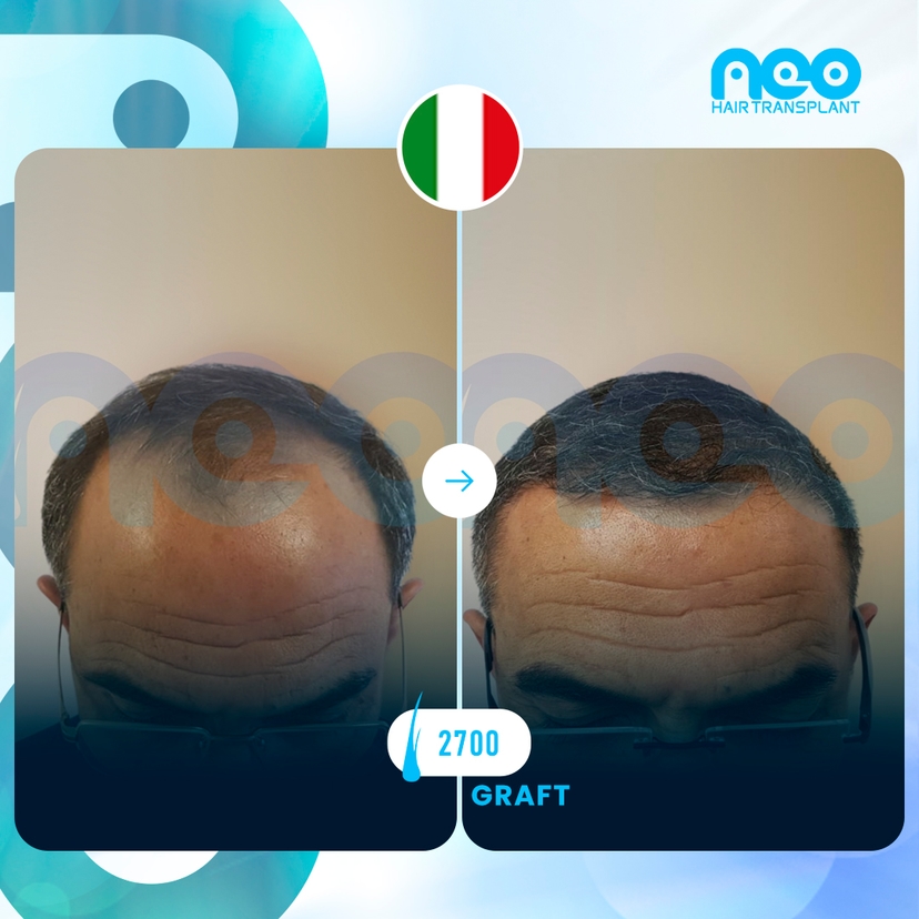 Neo Hair Before After 11