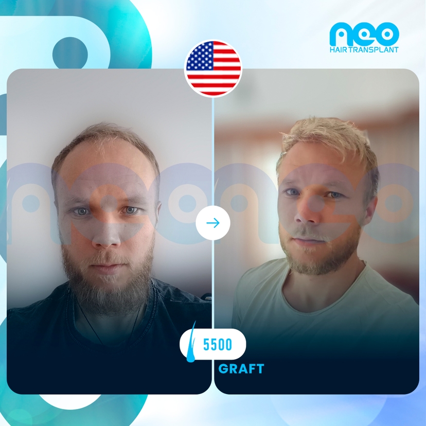 Neo Hair Before After 12