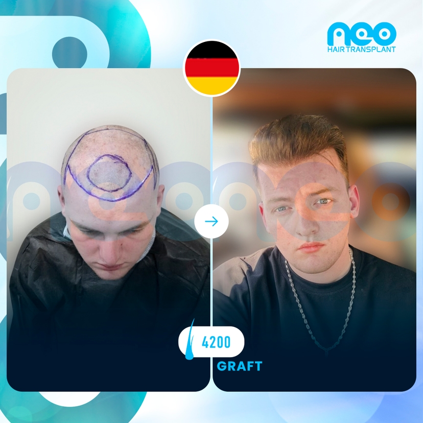 Neo Hair Before After 13