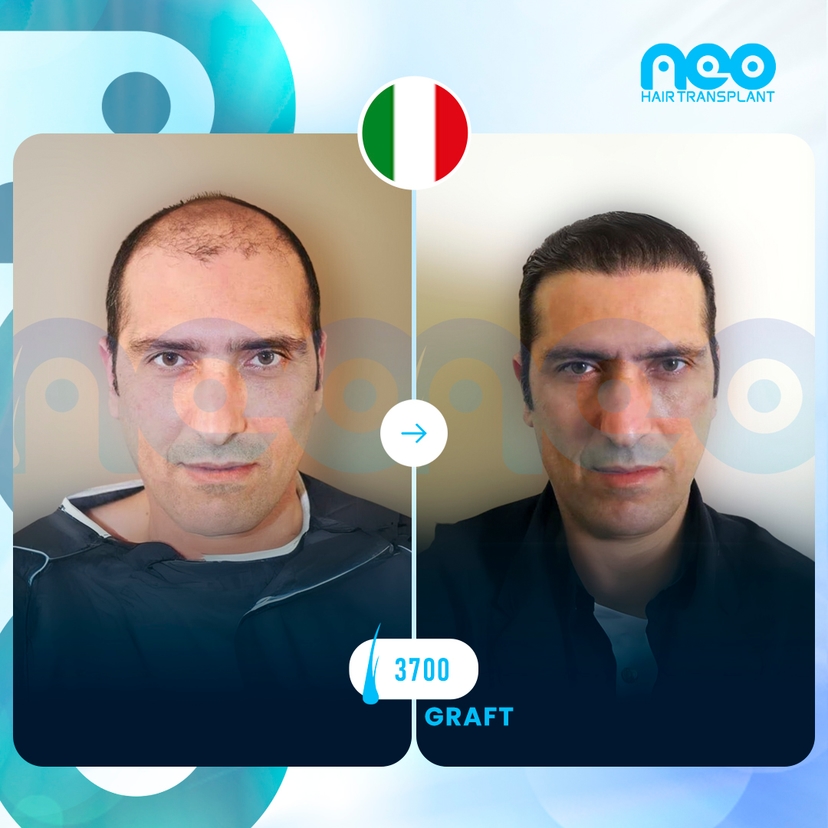 Neo Hair Before After 14