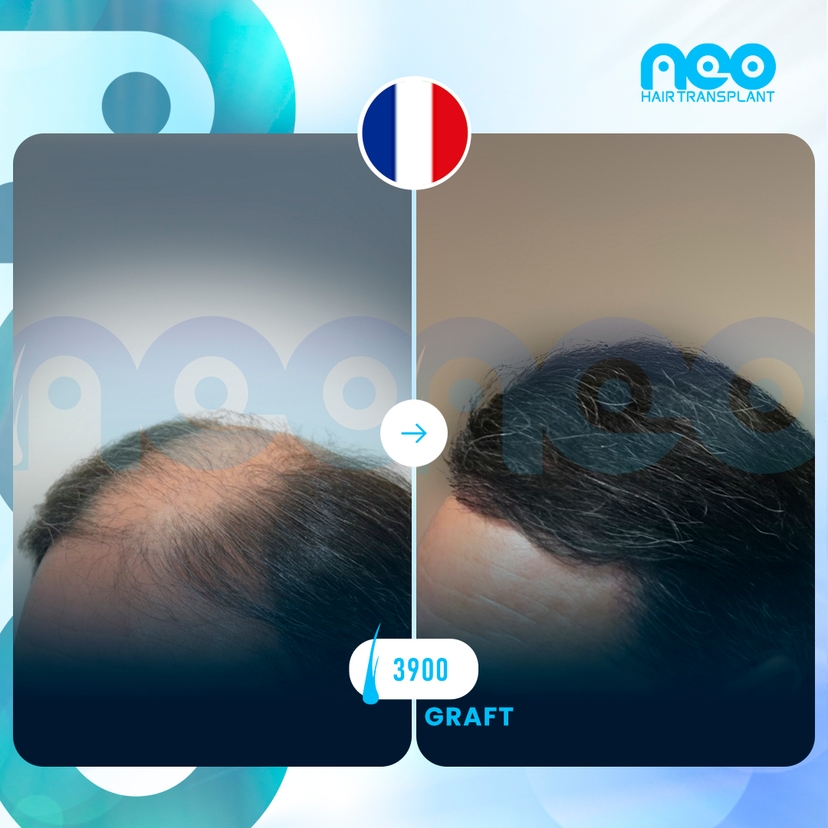 Neo Hair Before After 1
