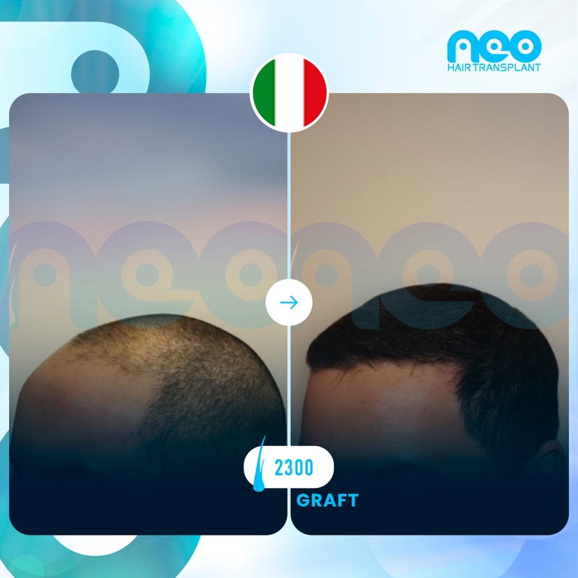 Neo Hair Before After 2