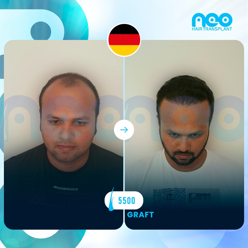 Neo Hair Before After 3