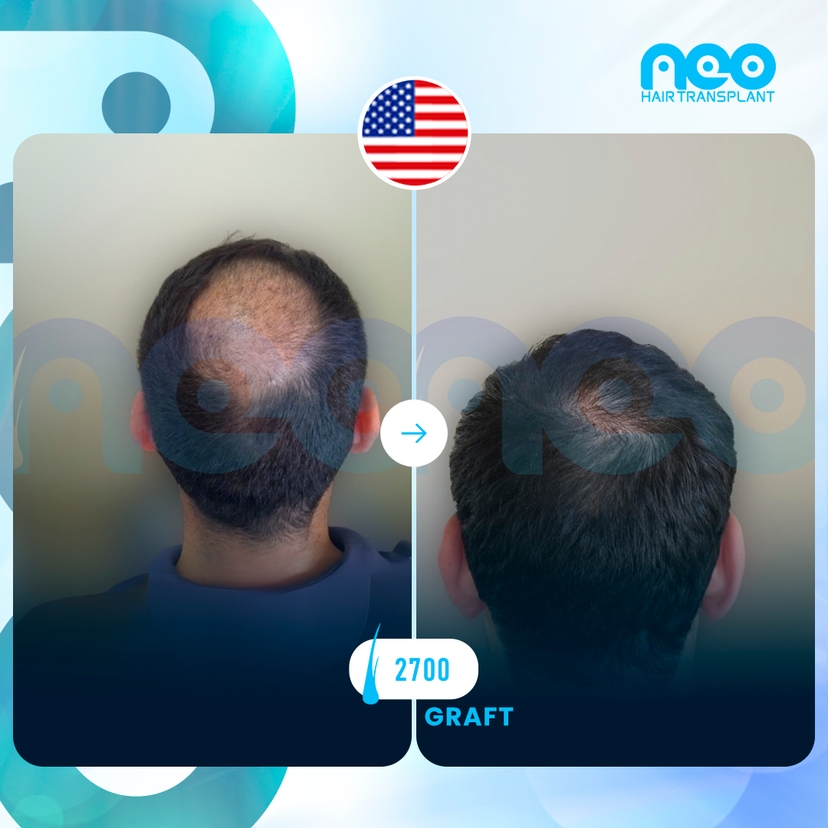 Neo Hair Before After 4