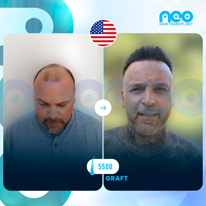 Neo Hair Before After 5