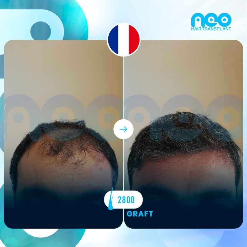 Neo Hair Before After 6