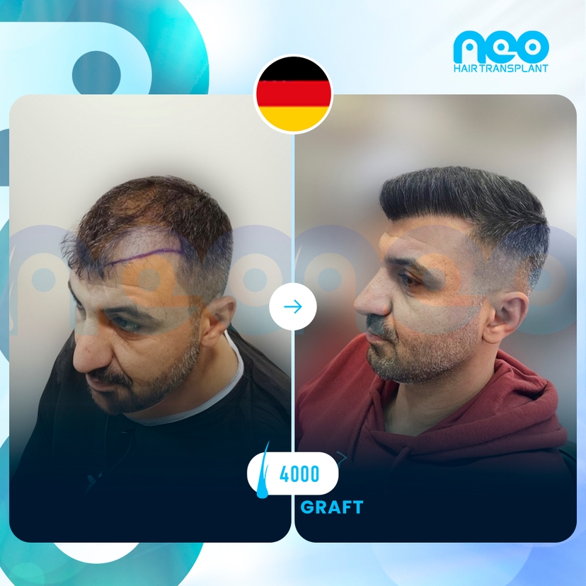 Neo Hair Before After 7