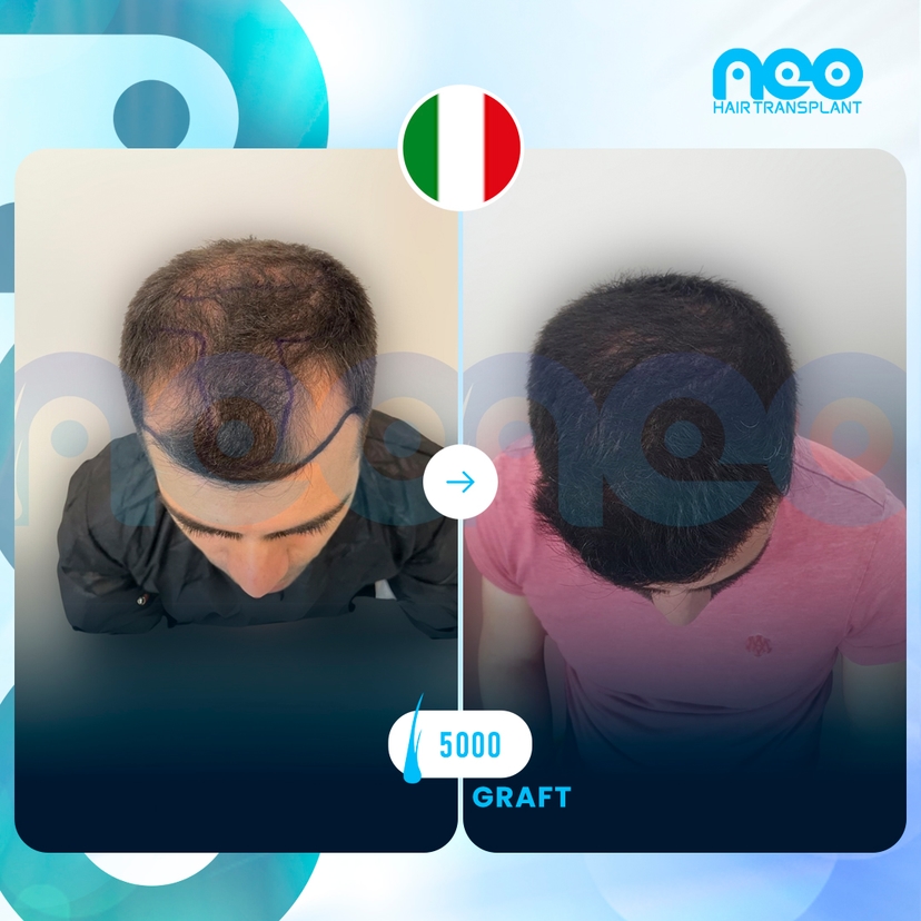 Neo Hair Before After 8